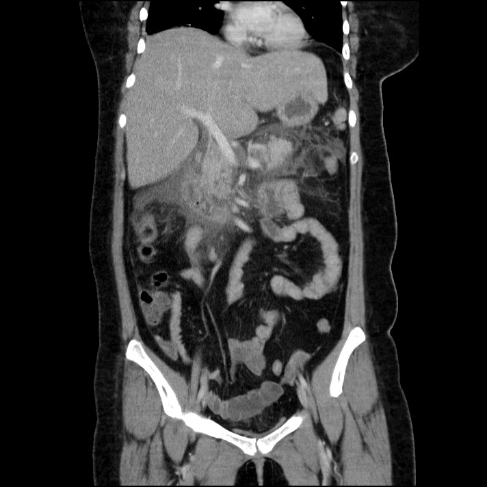 Acute pancreatitis (Radiopaedia 69236-79012 Coronal C+ portal venous phase 43).jpg