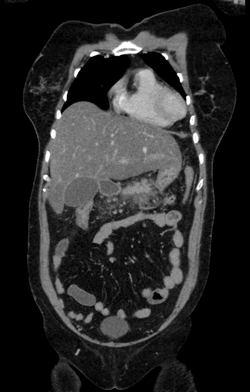 Acute pancreatitis (Radiopaedia 80007-93285 Coronal C+ portal venous phase 26).jpg
