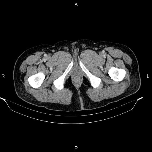 Acute pancreatitis (Radiopaedia 85390-101010 Axial C+ portal venous phase 117).jpg