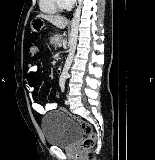 Acute pancreatitis (Radiopaedia 85390-101010 Sagittal C+ portal venous phase 54).jpg