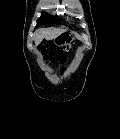 Acute pancreatitis (Radiopaedia 87428-103757 Coronal C+ portal venous phase 9).jpg