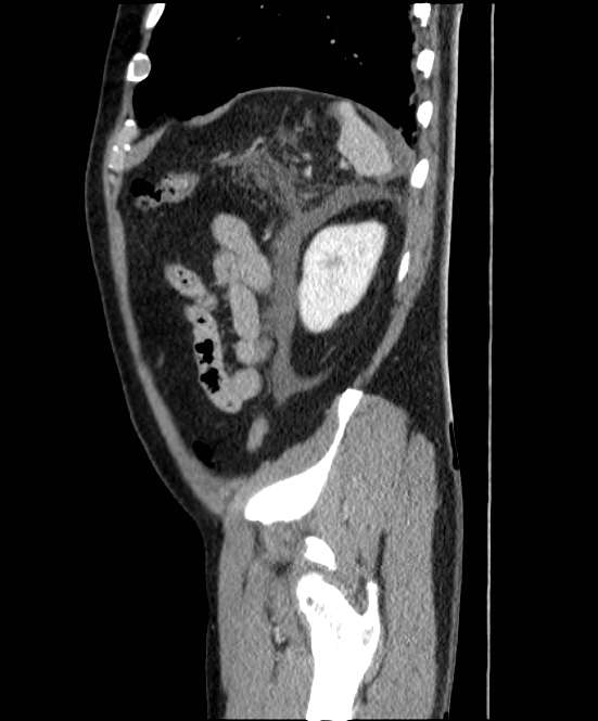 Acute pancreatitis - Balthazar E (Radiopaedia 23080-23110 Sagittal C+ portal venous phase 83).jpg