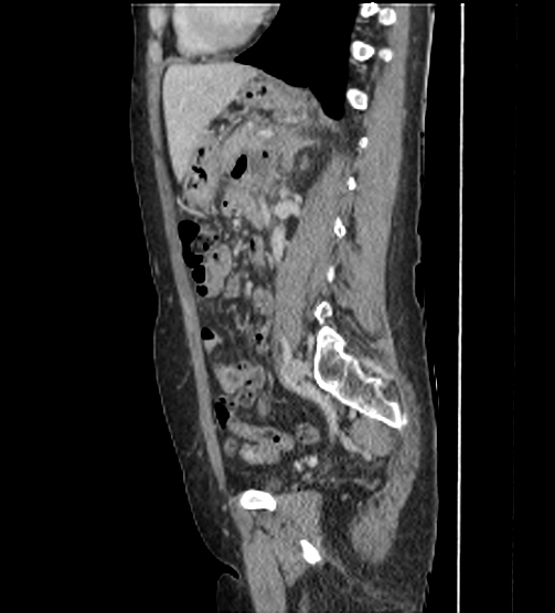 File:Acute pancreatitis - Balthazar E - post ERCP (Radiopaedia 27562-27772 Sagittal C+ portal venous phase 84).png