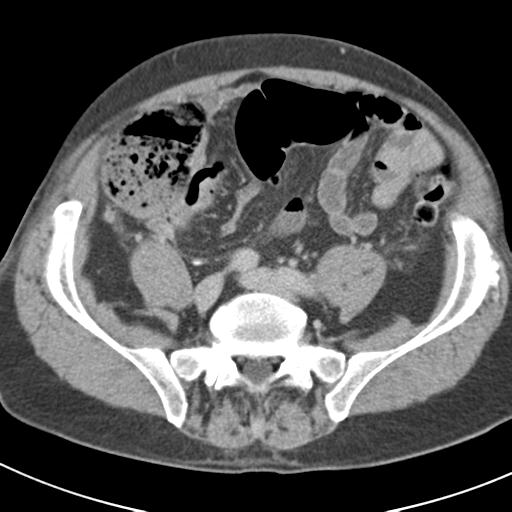 File:Acute pancreatitis and walled-off necrosis (Radiopaedia 29888-30403 Axial C+ delayed 60).jpg