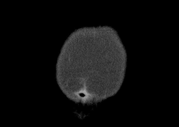 File:Acute pancreatitis and walled-off necrosis (Radiopaedia 29888-30403 Coronal C+ portal venous phase 4).jpg