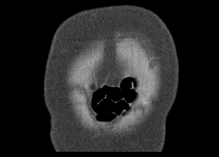 Acute pancreatitis and walled-off necrosis (Radiopaedia 29888-30403 Coronal C+ portal venous phase 7).jpg