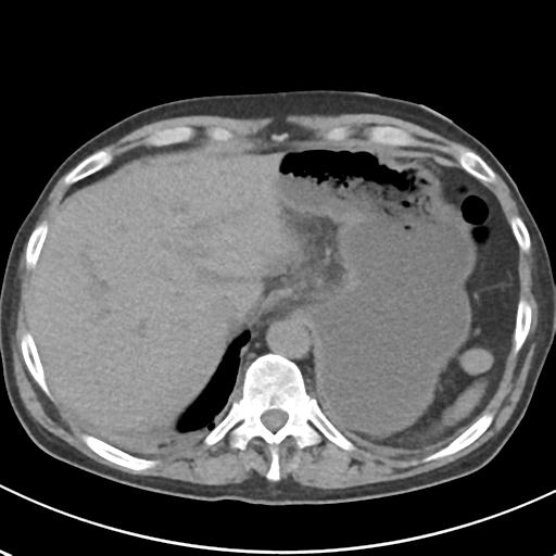 File:Acute pancreatitis and walled-off necrosis (Radiopaedia 29888-30404 Axial non-contrast 13).jpg