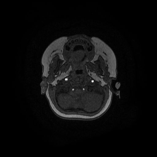 Acute phase of hemiconvulsion-hemiplegia epilepsy syndrome (Radiopaedia 29309-29745 Axial TOF angiography 148).jpg