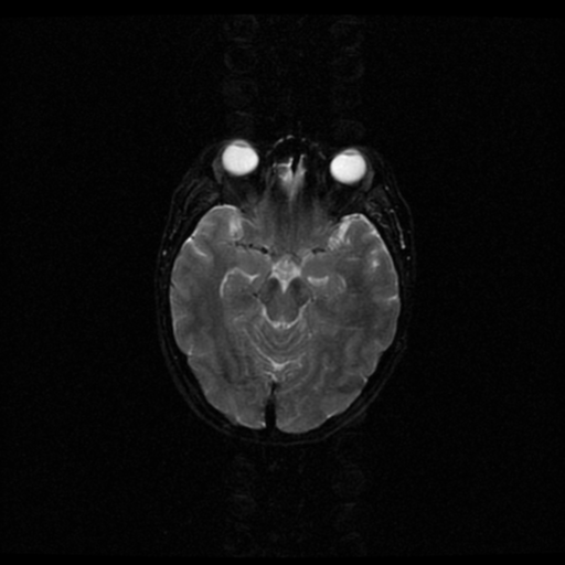 File:Acute pontine infarct from vertebral artery dissection (Radiopaedia 34111-35370 Axial Echo planar 7).png