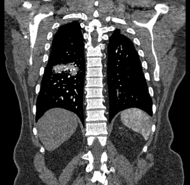 Acute pulmonary embolism with pulmonary infarcts (Radiopaedia 77688-89908 Coronal C+ CTPA 81).jpg