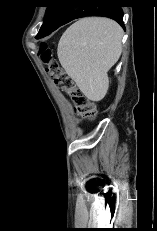 Acute renal infarction - rim capsular enhancement (Radiopaedia 59833-67270 Sagittal C+ portal venous phase 76).jpg