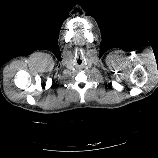 File:Acute segmental pulmonary emboli and pulmonary infarction (Radiopaedia 62264-70444 Axial C+ CTPA 2).jpg