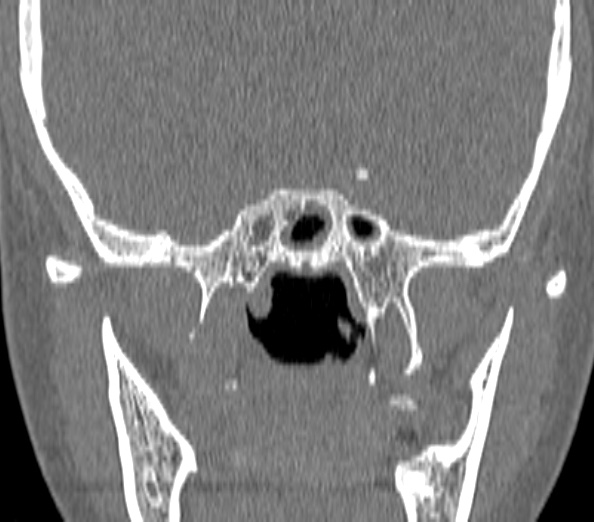Acute sinusitis (Radiopaedia 40564-43158 Coronal bone window 39).jpg
