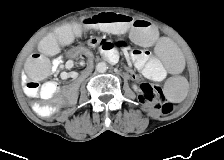 Acute small bowel (ileal) volvulus (Radiopaedia 71740-82139 Axial C+ portal venous phase 109).jpg