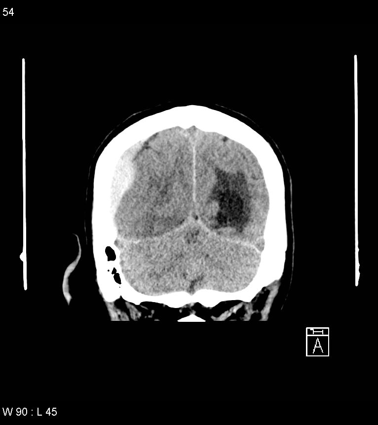 Acute subdural hematoma with myelofibrosis (Radiopaedia 52582-58494 Coronal non-contrast 45).jpg
