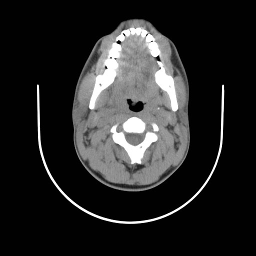 File:Acute submandibular sialadenitis secondary to ductal stone (Radiopaedia 27999-28267 Axial non-contrast 6).jpg