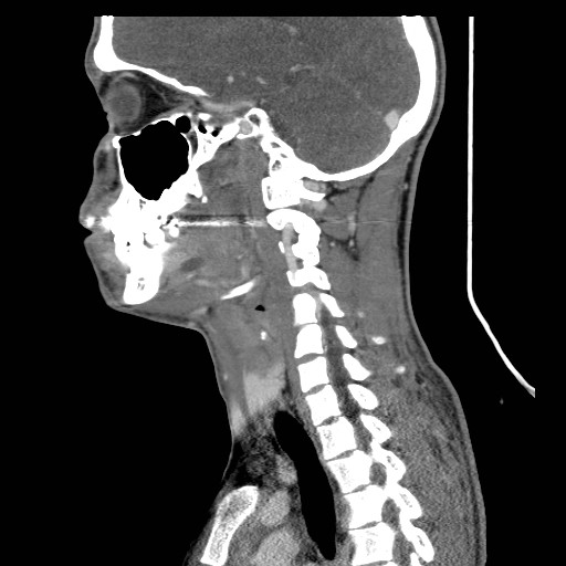 File:Acute submandibular sialadenitis secondary to ductal stone (Radiopaedia 27999-28267 Sagittal C+ delayed 17).jpg