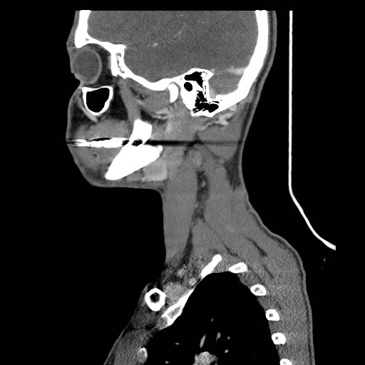 File:Acute submandibular sialadenitis secondary to ductal stone (Radiopaedia 27999-28267 Sagittal C+ delayed 36).jpg