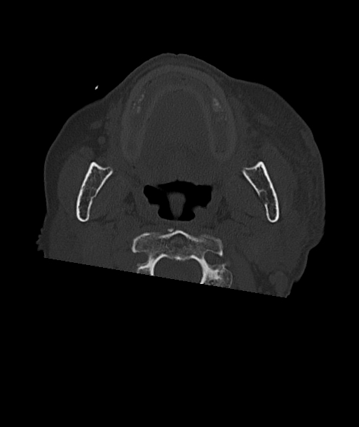 Acute traumatic subdural hematoma (Radiopaedia 82921-97257 Axial bone window 112).jpg