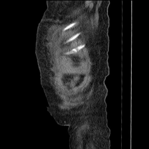 Acute tubular necrosis (Radiopaedia 28077-28334 Sagittal non-contrast 8).jpg