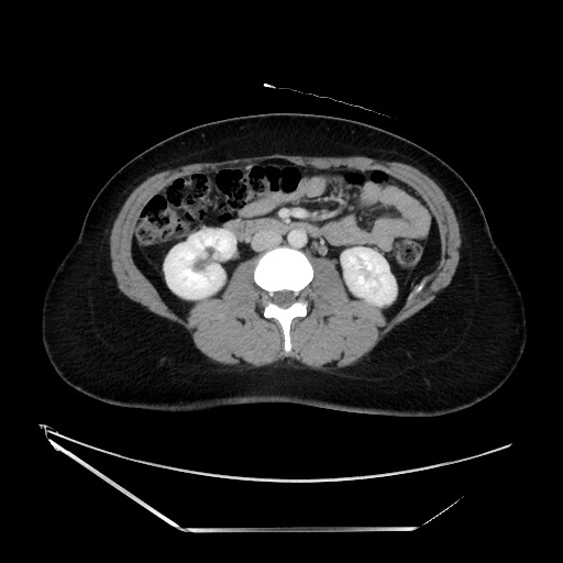 Acute uncomplicated appendicitis (Radiopaedia 73704-84499 Axial C+ portal venous phase 72).jpg