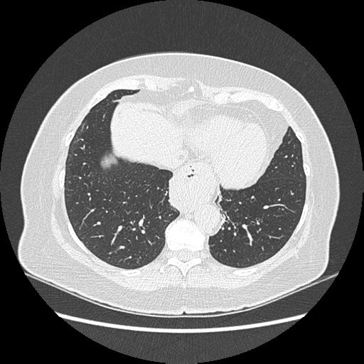 Adenocarcinoma in situ of lung (Radiopaedia 38685-40829 B 170).png