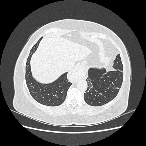 Adenocarcinoma in situ of lung (Radiopaedia 38685-40829 B 182).png