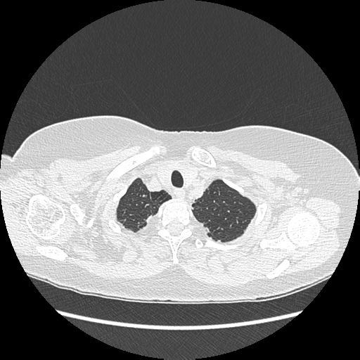 Adenocarcinoma in situ of lung (Radiopaedia 38685-40829 B 24).png