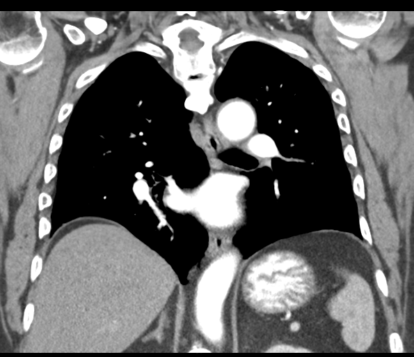 Adenocarcioma of rectum- T1 lesion (Radiopaedia 36921-38547 Coronal C+ arterial phase 39).png
