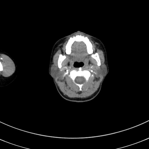 Adenocystic carcinoma of the trachea (Radiopaedia 47677-52525 Axial C+ arterial phase 9).jpg