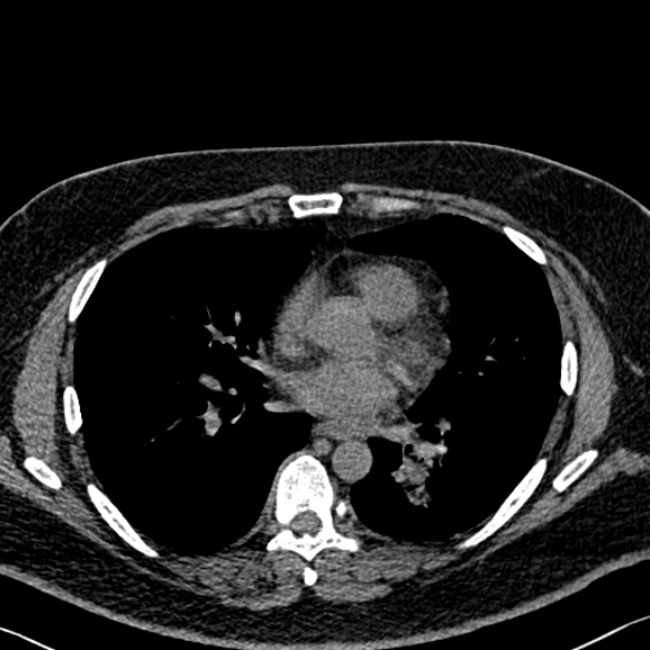 Adenoid cystic carcinoma of the trachea (Radiopaedia 49042-54137 Axial non-contrast 194).jpg