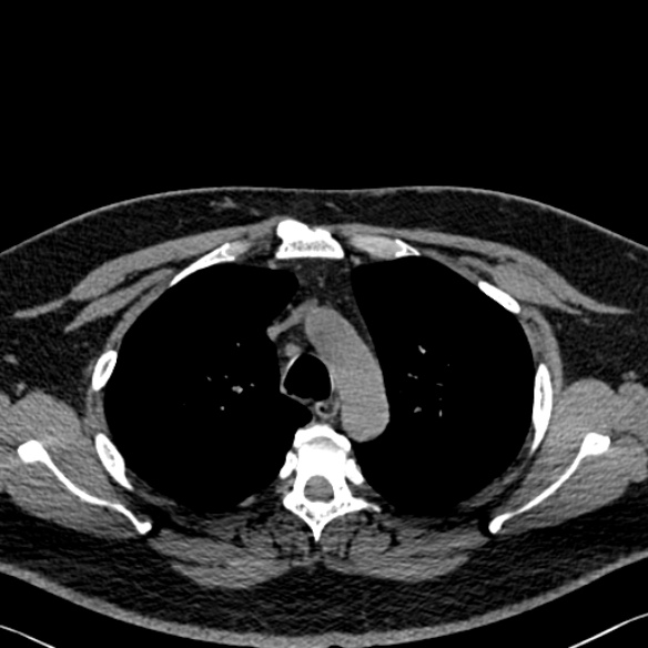 Adenoid cystic carcinoma of the trachea (Radiopaedia 49042-54137 Axial non-contrast 94).jpg