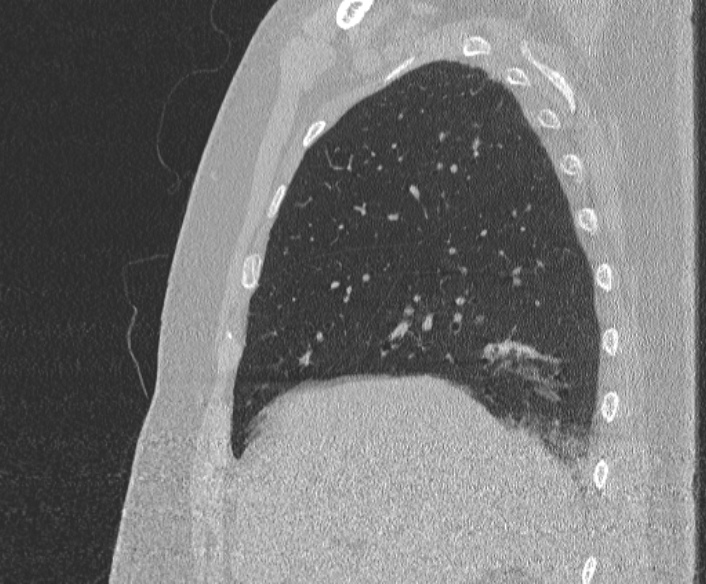 Adenoid cystic carcinoma of the trachea (Radiopaedia 49042-54137 Sagittal lung window 127).jpg