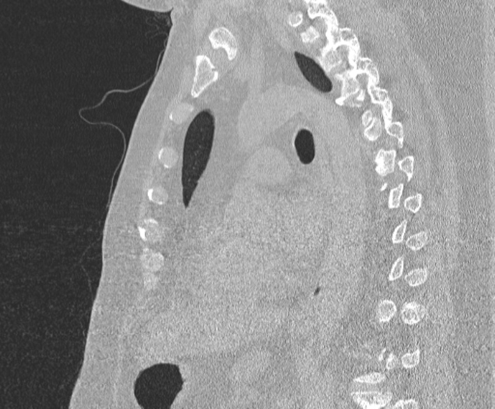 Adenoid cystic carcinoma of the trachea (Radiopaedia 49042-54137 Sagittal lung window 262).jpg
