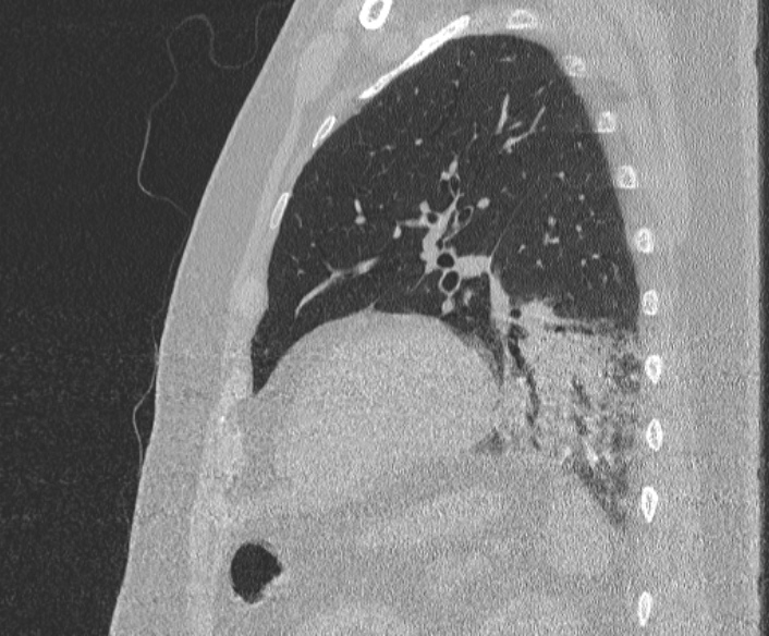 Adenoid cystic carcinoma of the trachea (Radiopaedia 49042-54137 Sagittal lung window 332).jpg