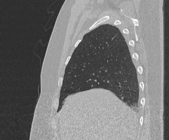 Adenoid cystic carcinoma of the trachea (Radiopaedia 49042-54137 Sagittal lung window 95).jpg