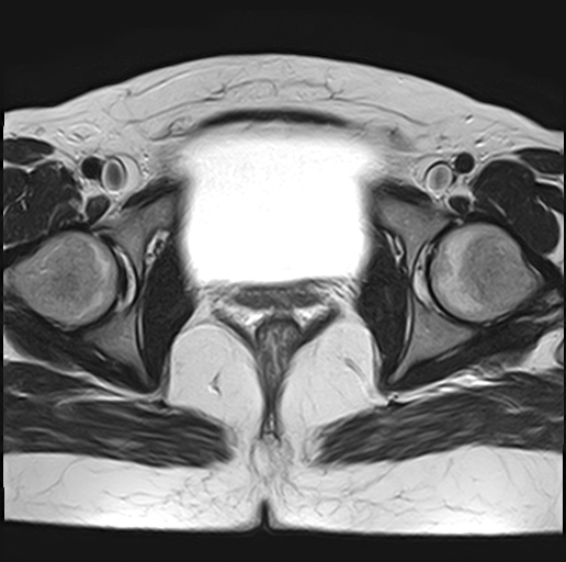 File:Adenomyosis - ovarian endometriomas (Radiopaedia 67031-76350 Axial T2 22).jpg