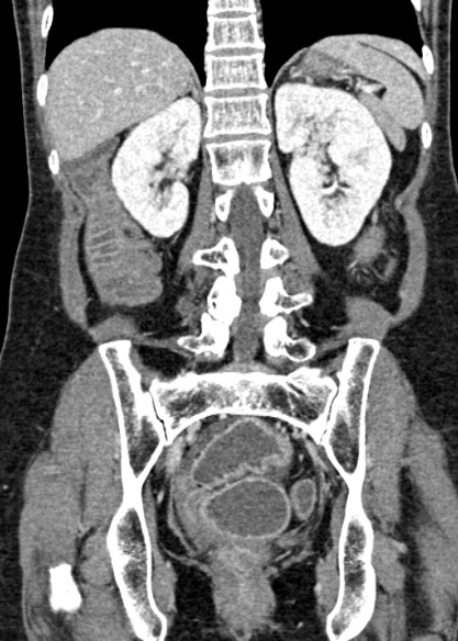 Adhesional small bowel obstruction (Radiopaedia 48397-53305 Coronal C+ portal venous phase 243).jpg