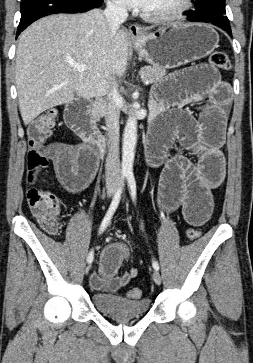 Adhesional small bowel obstruction (Radiopaedia 58900-66131 Coronal C+ portal venous phase 139).jpg