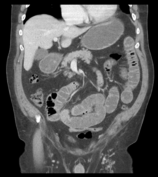 Adhesions within abdominal wall hernia (Radiopaedia 58283-65394 Coronal C+ portal venous phase 31).png