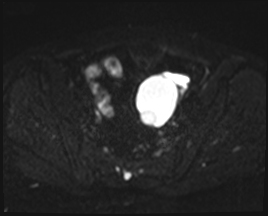 File:Adnexal multilocular cyst (O-RADS US 3. O-RADS MRI 3) (Radiopaedia 87426-103754 Axial 142).jpeg