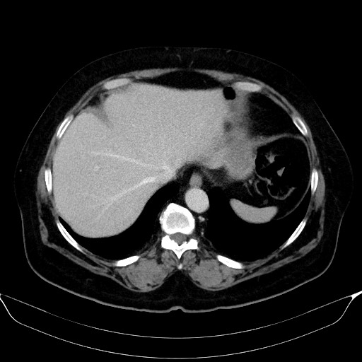 Adrenal cortical carcinoma (Radiopaedia 64017-72769 Axial C+ portal venous phase 9).jpg