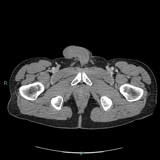File:Adrenal cystic lymphangioma (Radiopaedia 83161-97534 Axial C+ portal venous phase 105).jpg