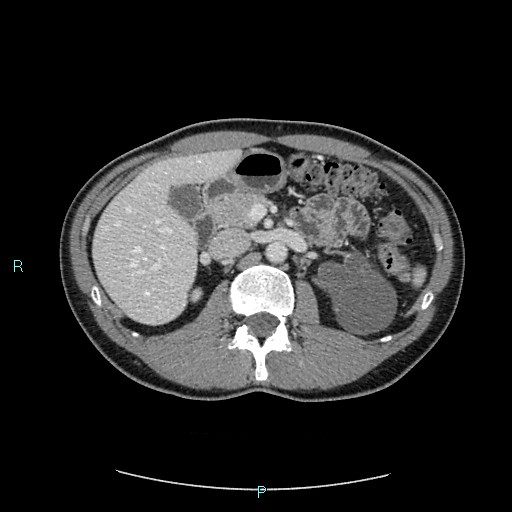 Adrenal cystic lymphangioma (Radiopaedia 83161-97534 Axial C+ portal venous phase 34).jpg
