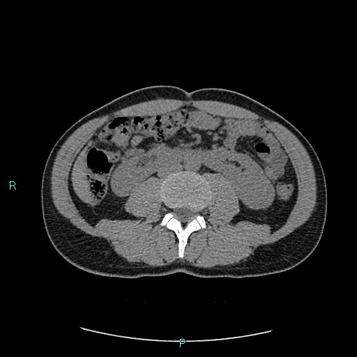 Adrenal cystic lymphangioma (Radiopaedia 83161-97534 Axial non-contrast 51).jpg