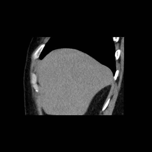 Adrenal gland trauma (Radiopaedia 81351-95079 Sagittal non-contrast 15).jpg