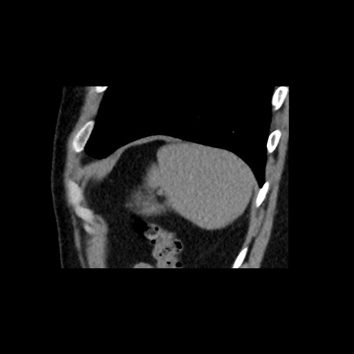 Adrenal gland trauma (Radiopaedia 81351-95079 Sagittal non-contrast 88).jpg