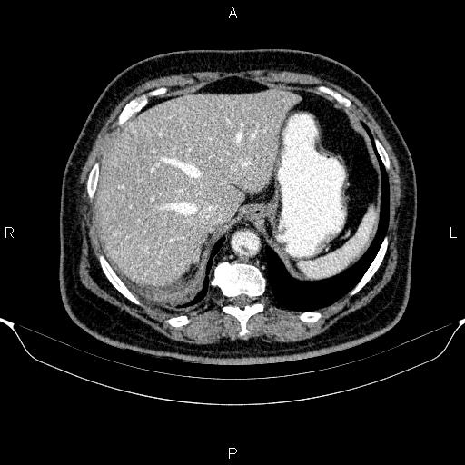 Adrenal hemorrhage (Radiopaedia 62622-70916 Axial C+ portal venous phase 27).jpg