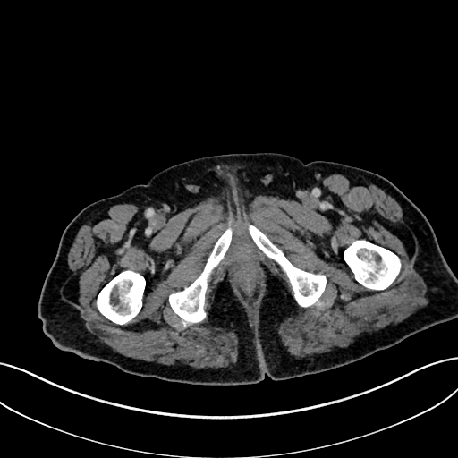 Adrenal lymphoma (Radiopaedia 73730-84529 Axial C+ portal venous phase 136).jpg