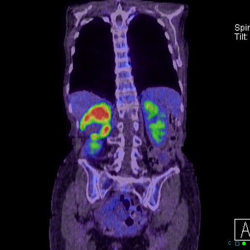 File:Adrenal metastasis from small cell lung cancer (Radiopaedia 19133-19109 Coronal 24).jpg